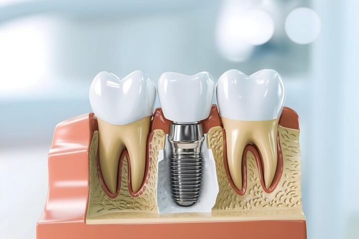 Complete Guide to Dental Implants: Procedure, Benefits, and Aftercare Tips